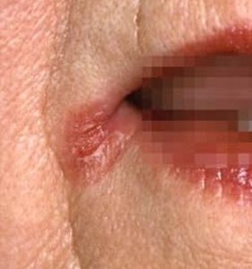 Tulehtuneet suupielet - mikä avuksi?